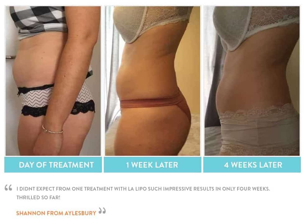 before, Cryolipolysis Ashford