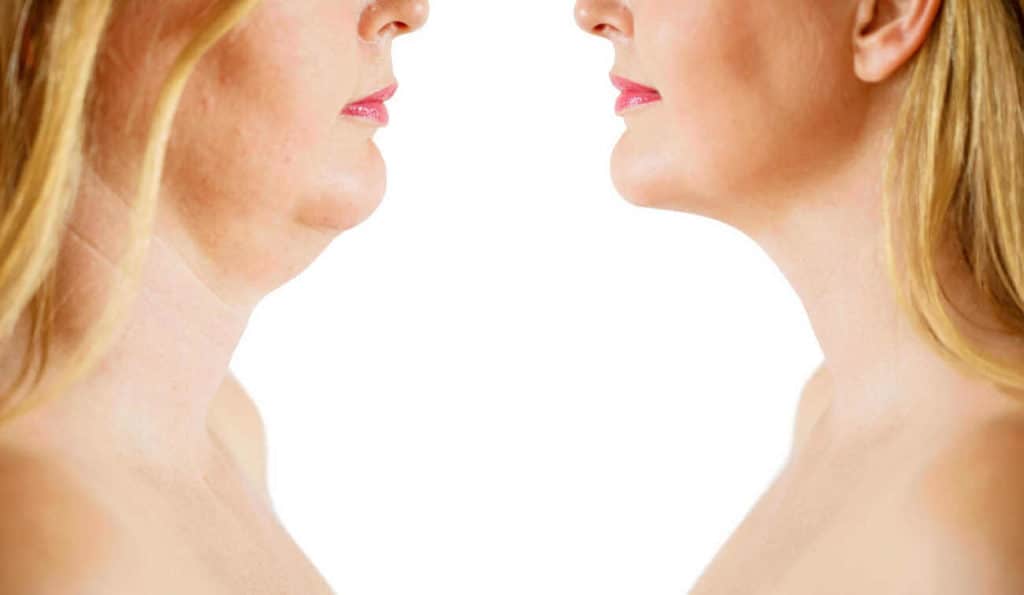 Double Chin treatment Ashford before and after results