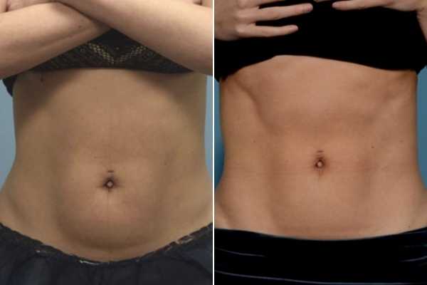 body sculpting FAQs Ashford