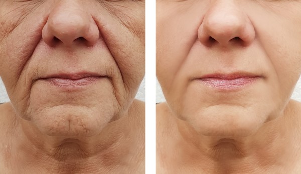 Learn more about Morpheus8 Treatment Ashford today!