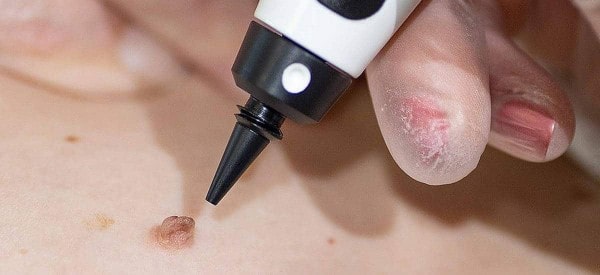After Skin Tag Removal Ashford