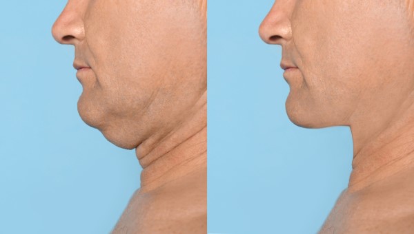 Which Non-Surgical Treatments Work Best for Jowls and Loose Skin Ashford?