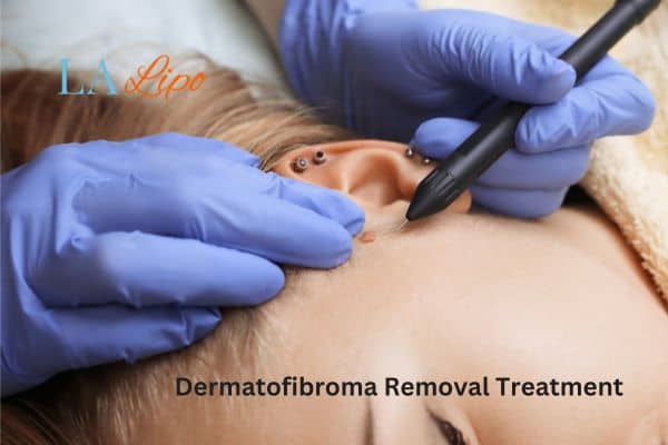Dermatofibroma Removal Treatment Ashford