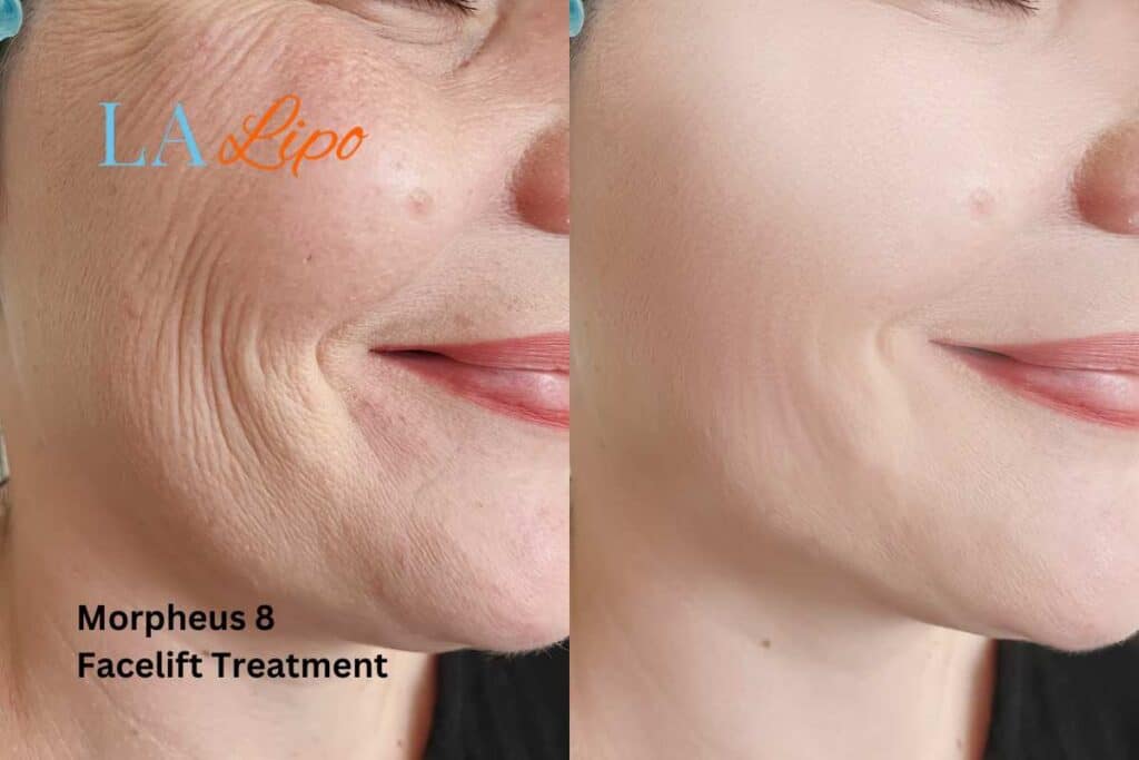 Morpheus8 Treatment Ashford for flawless skin! Call us today!
