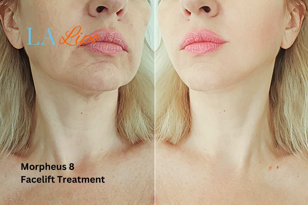 Turn back time with Morpheus8 Treatment Ashford