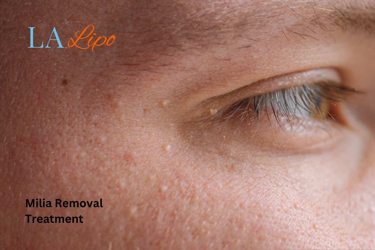 Cryopen Milia Removal: Is It the Easiest and Safest Option Ashford?