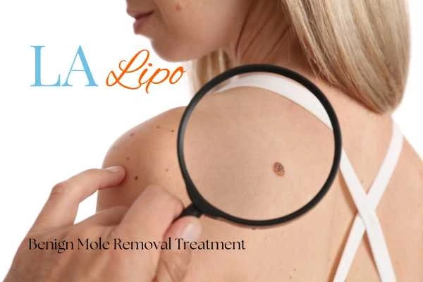 Woman having her inspection of blemish before mole removal Ashford