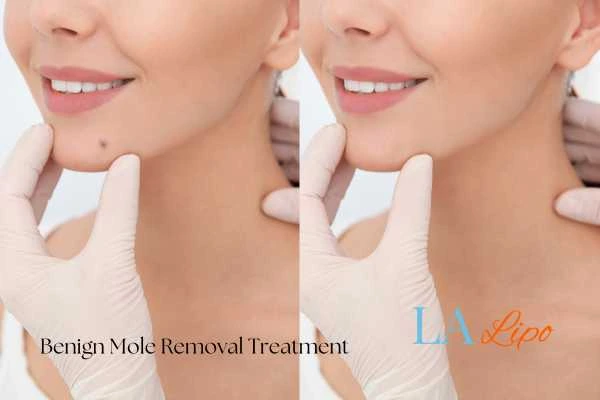 woman's before and after mole removal Ashford results