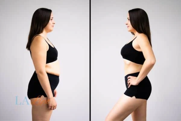 LA-EMS Body Sculpting Ashford results before and after of womans results on body toning.