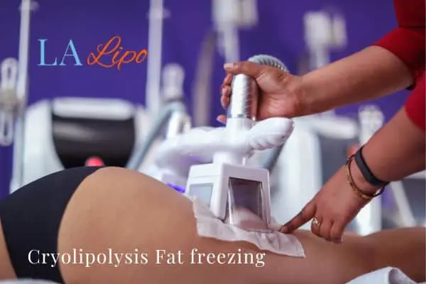 women getting fat freezing Ashford