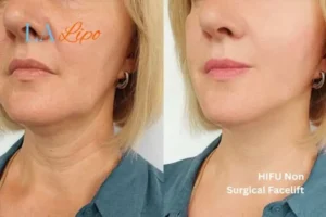 hi-fu for wrinkles Ashford before and after results