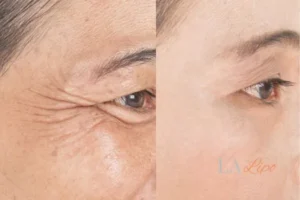 Before and after results of woman - HI-fu wrinkles reduction treatment Ashford