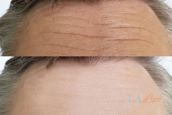 results of HIFU Ashford on mans forehead to help reduce lines and wrinkles