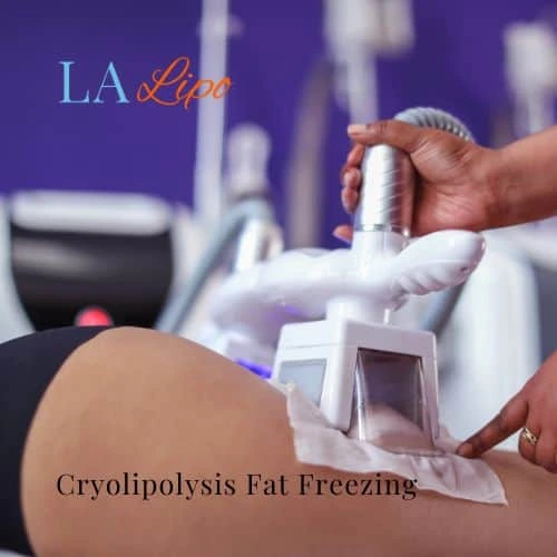 fat freezing - Cryolipolysis Ashford