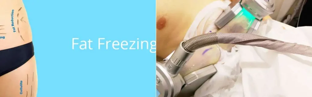 Fat freezing Ashford on multiple areas of the body