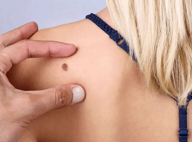 woman having mole removal Ashford consultation before treatment.