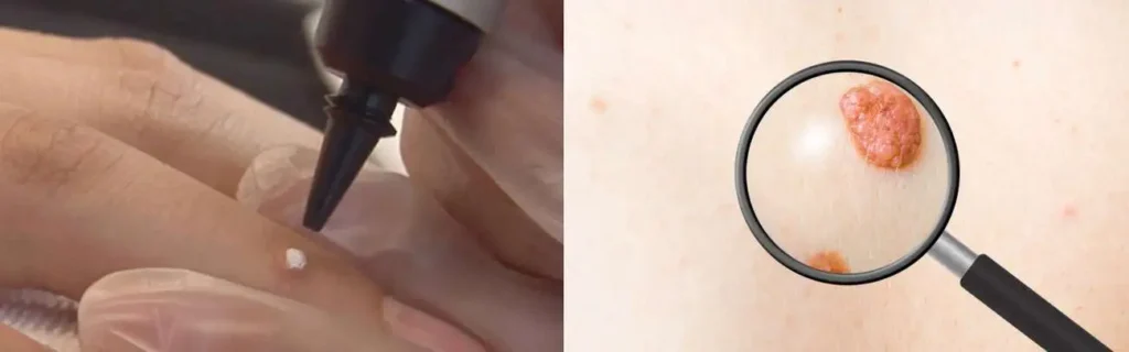 Cryopen for mole removal Ashford - speak to our team today!