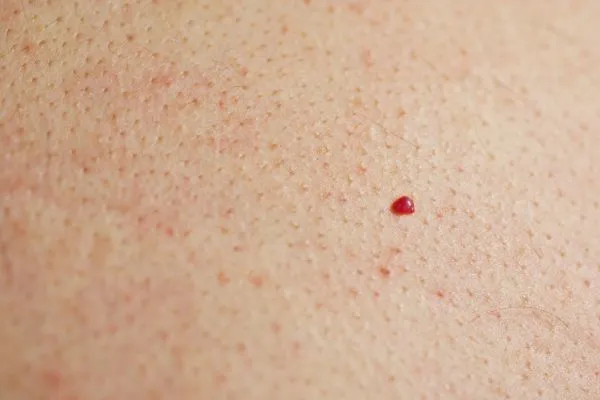 close up of a cherry angioma Ashford