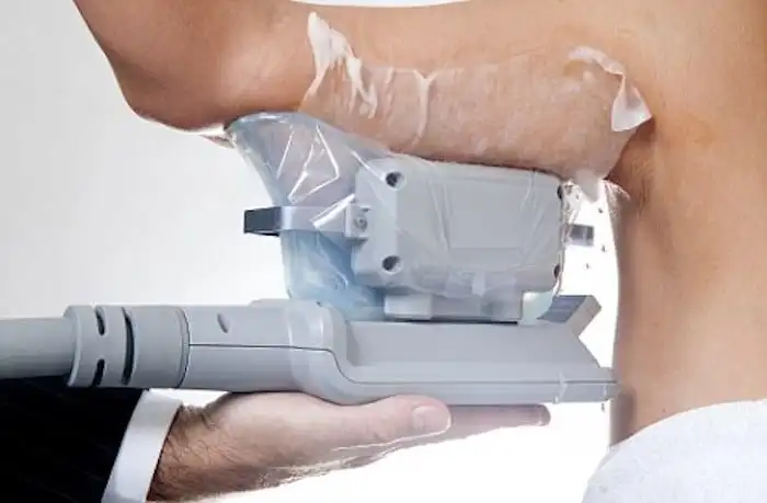 Picture of fat freezing Ashford on the upper arms.