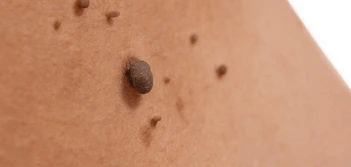 image of a skin tag Ashford