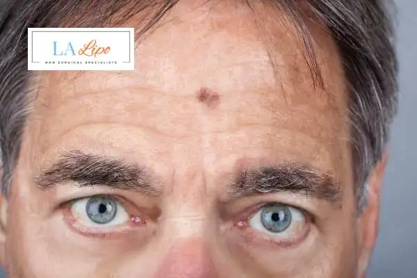 Solar Lentigo Removal Ashford image of man with mark on his forehead