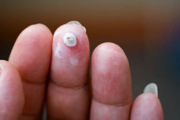 wart on person finger - cryotherapy to treat from LA LIPO Ashford