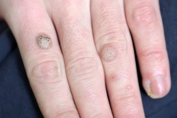 photo of warts on person hand - see wart removal Ashford from LA LIPO