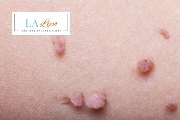 Does cryopen skin tag removal Ashford hurt? Find out now call our team today!