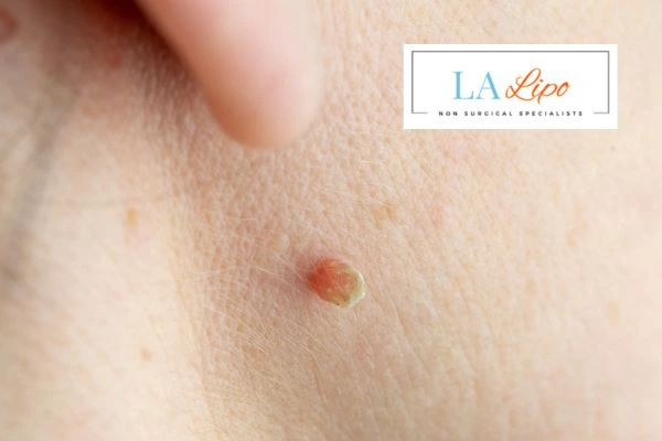 Book skin tag removal Ashford today speak to our team now!