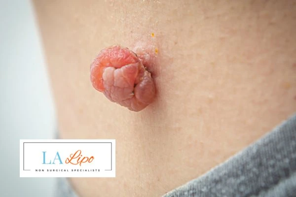 Interested in skin tag removal Ashford? Concerned about the pain? Find out more today!