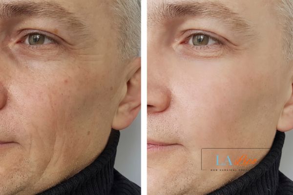 See the amazing results of Morpheus8 Treatment Ashford!