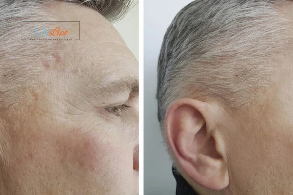 Mens Before & After Morpheus 8 Results Ashford