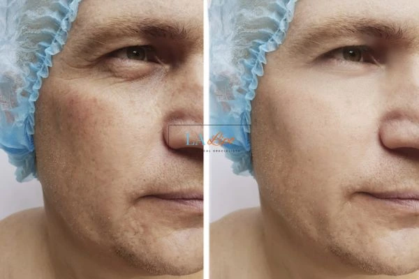Before and after Morpheus 8 Results Ashford