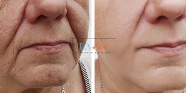Older lady deeper wrinkle reduction - LA LIPO Morpheus 8 Results Ashford