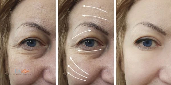 Amazing eye lift Morpheus 8 results Ashford