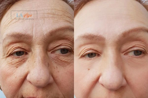 The powerful benefits of Morpheus8 Treatment Ashford - Call Our team today!