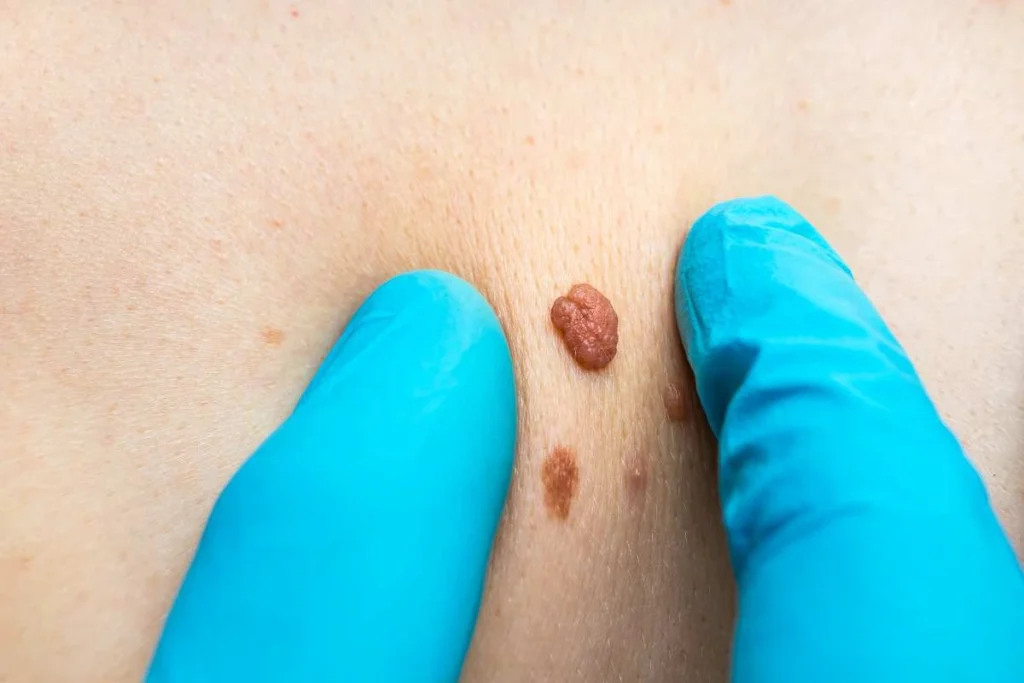 LA LIPO Cryopen Lesion Removal Prices Ashford