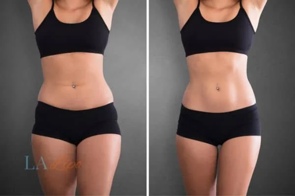 before and after results of non-surgical treatment to help a woman's body image and mental health Ashford