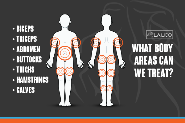 Diagram to show areas you can have LA-EMS Body Sculpting Treatment Ashford