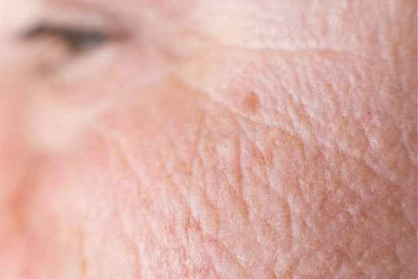 close up picture of a woman's face showing an age spot Ashford