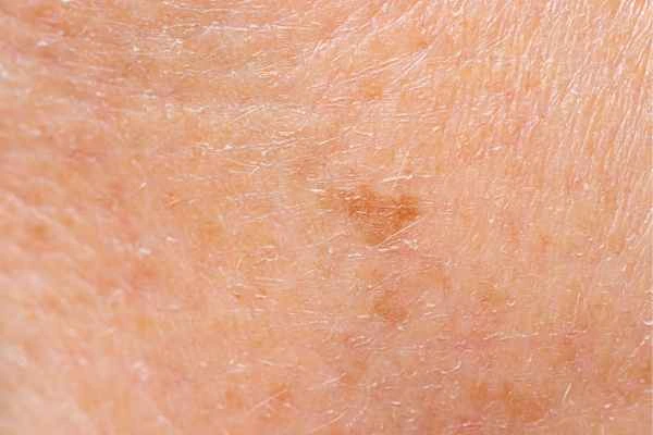 close up picture of age spots Ashford