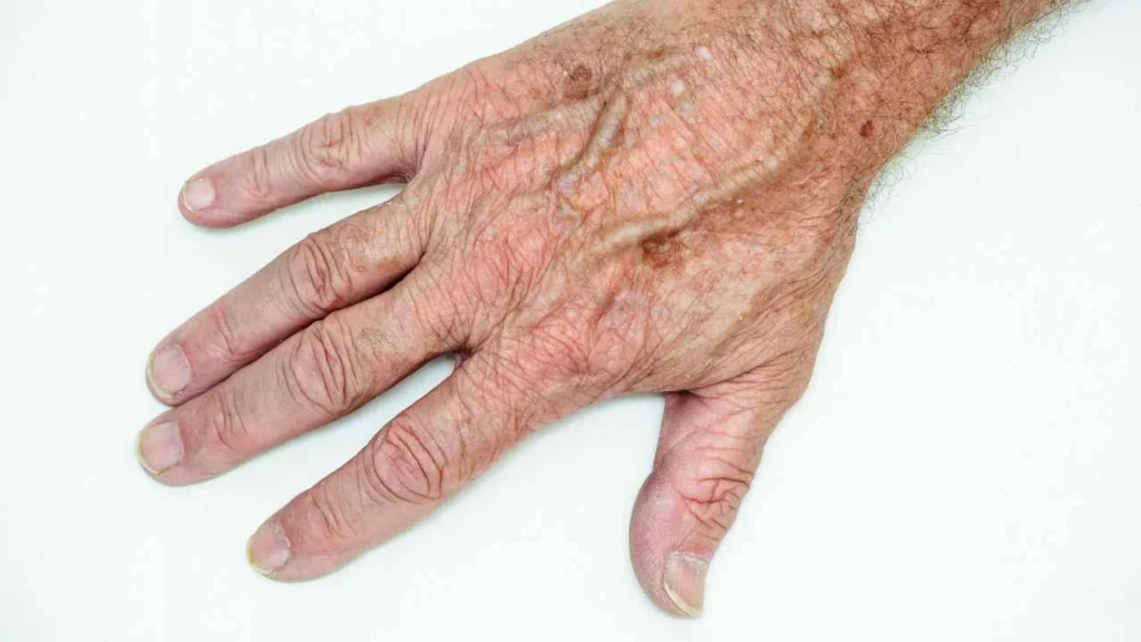 Male hand showing age spot Ashford