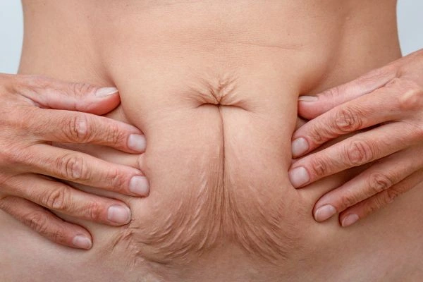 Image of a woman's stomach with loose skin - example of skin tightening Ashford options