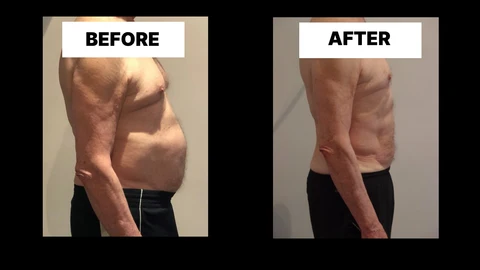 What Symptoms Can Diastasis Recti Cause in Men? Weak Core, Back Pain and Poor Posture Ashford